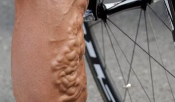 varices chez un cycliste